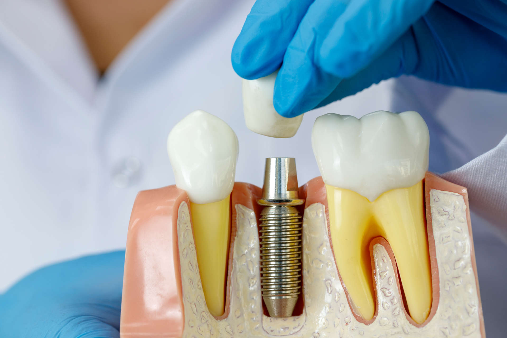 A image of Dental Implants