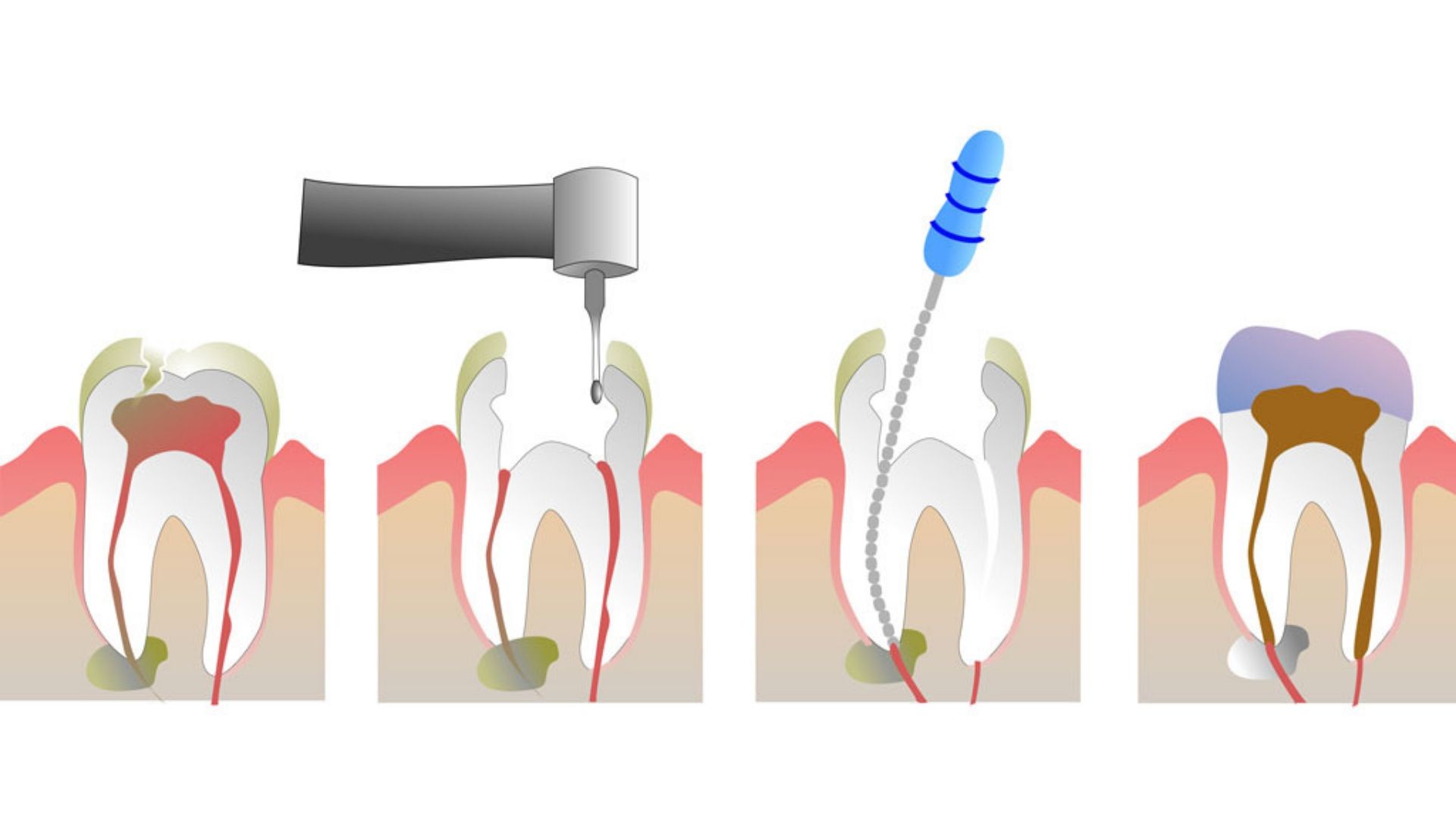 A image of Root Canal