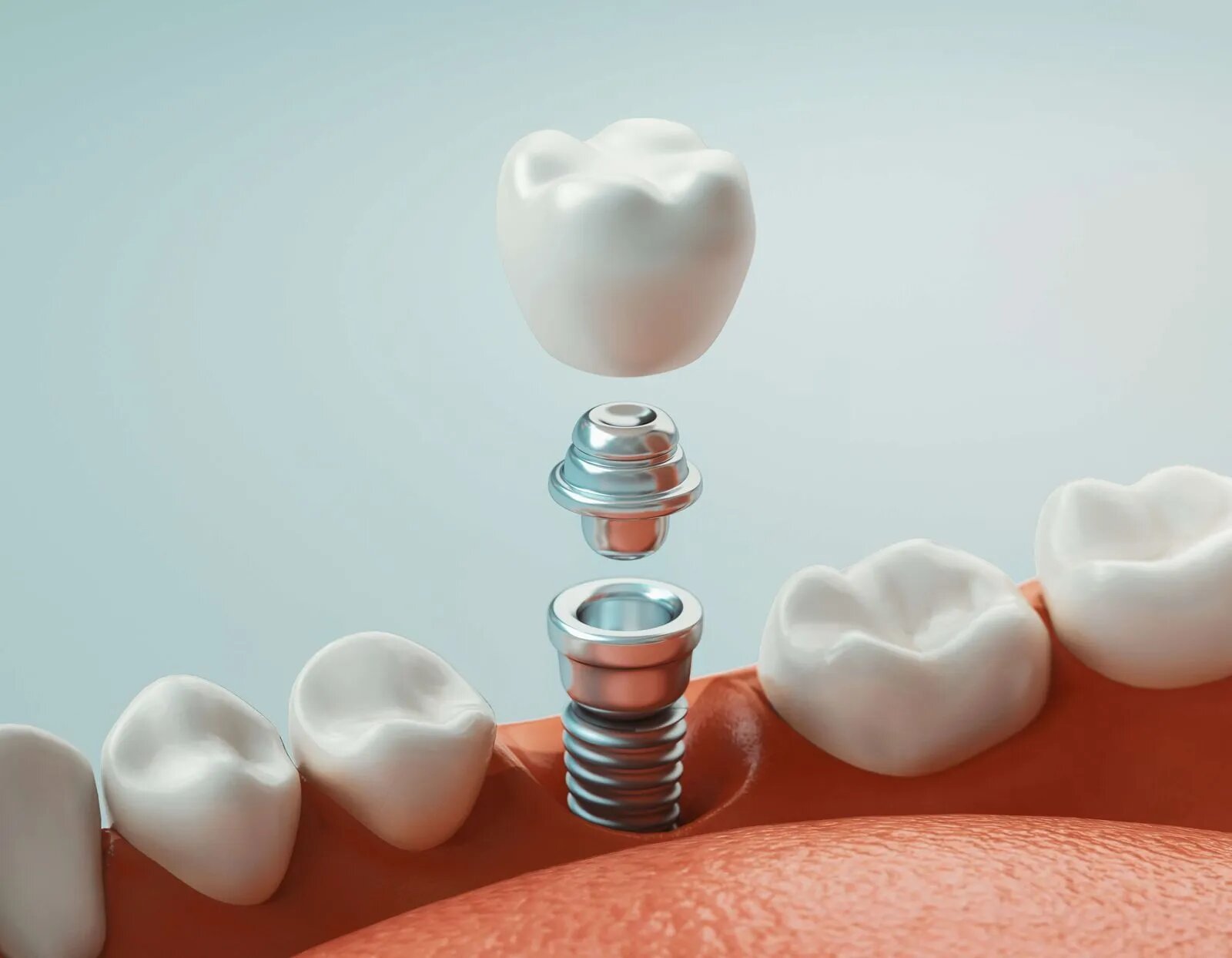Dental Implants in Lake Havasu
