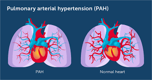 pulmonary arterial hypertension